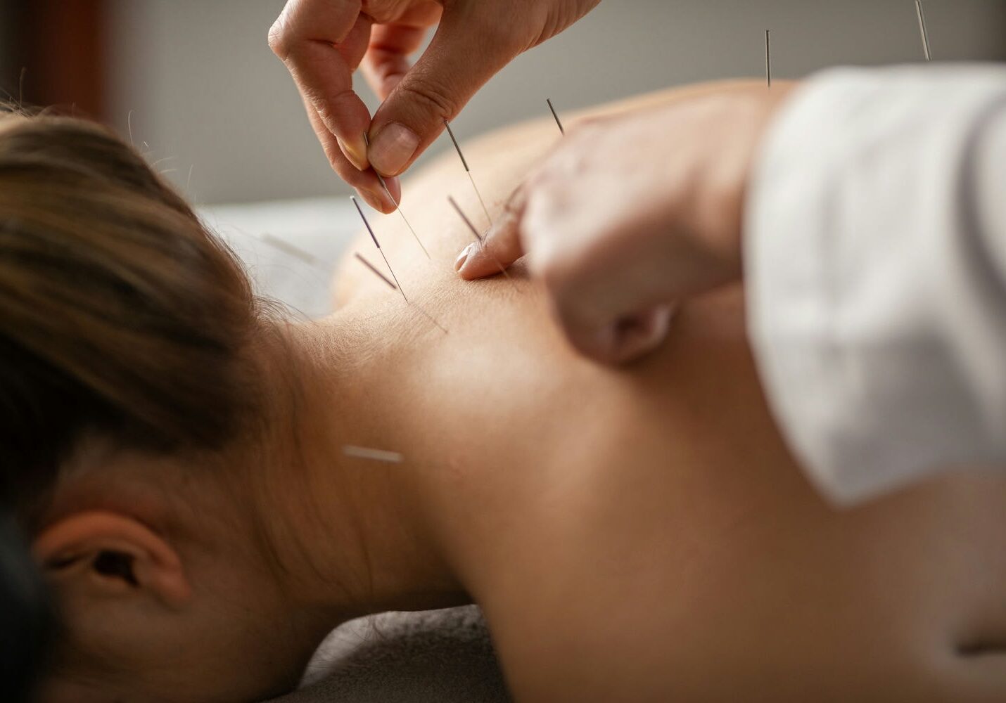 Acupuncturist inserting fine needles into a patient’s back for pain management therapy.