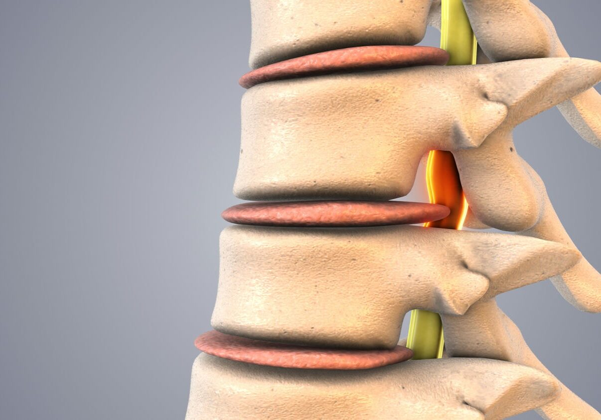 3D close-up of lumbar vertebrae showing a bulging disc pressing on a spinal nerve, treated with decompression therapy.
